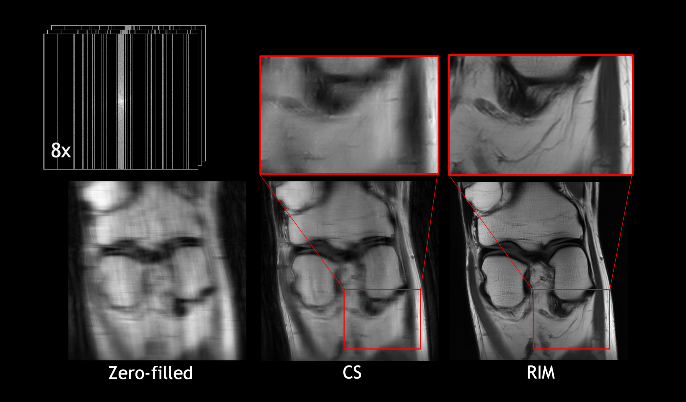 DIRECT reconstruction example: zero-filled input, compressed sensing, and RIM reconstruction